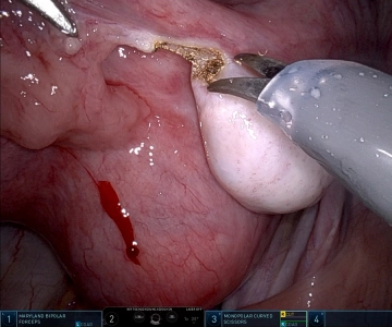 Right salpingectomy