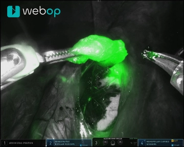 Pelvic Biopsy of the sentinel node 2