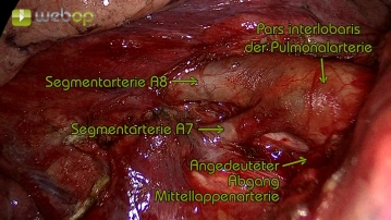 Dissection of the segmental artery A8