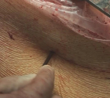 Penetration of the Abdominal Wall