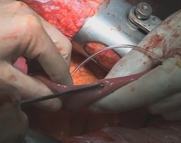 Puncture of the Jejunum