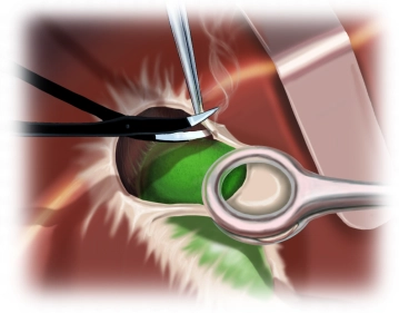 Exploration, subserous anterograde extirpation of the gallbladder