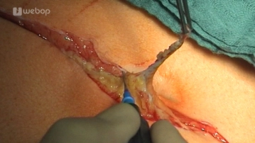 Excision of the old scar