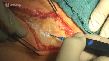 Opening of the Abdomen
