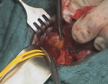 Removal of the right upper parathyroid gland