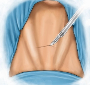 Kocher's collar incision