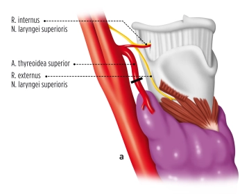 Mobilization of the upper right thyroid pole