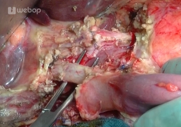 Exploration – Preparation of the Ligamentum hepatoduodenale
