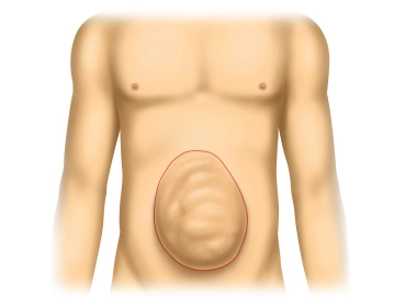 Skin Incision