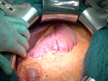 Transverse Upper Abdominal Laparotomy