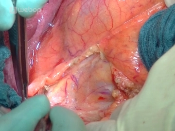 Mobilization of the right colonic flexure/Kocher maneuver