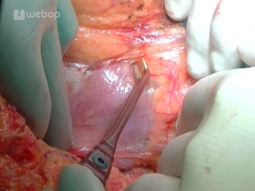 Exposure of the Inferior Pancreatic Border and the Mesentericoportal Venous Axis