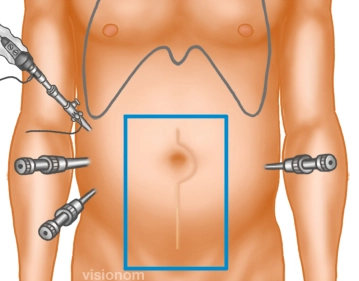 Insertion of Trocars