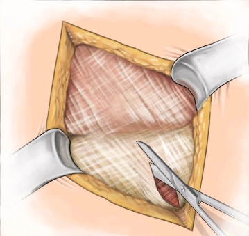 Splitting of the external aponeurosis