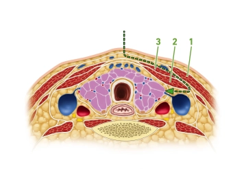 الدخول إلى حجرة الغدة الدرقية عند الحافة الأمامية للعضلة القصية الترقوية الخشائية (Musculus sternocleidomastoideus)