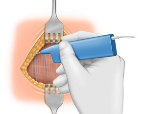 Mobilization of Wound Edges