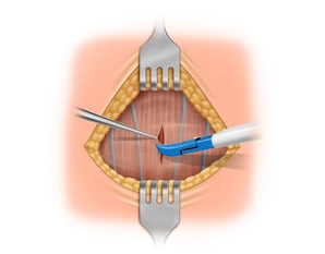 Division of the Straight Neck Muscles