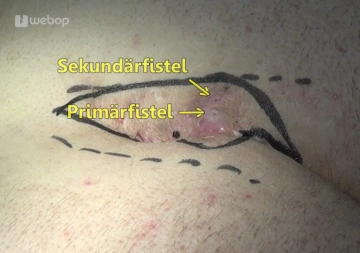 Planning of Resection