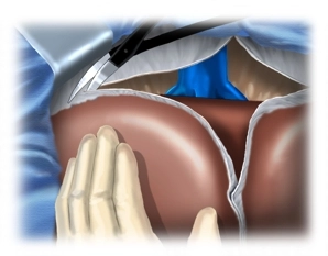 Mobilization of the Liver