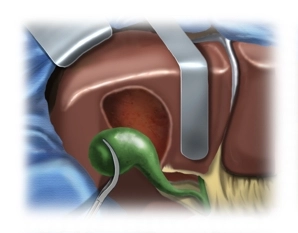 Mobilization of the Gallbladder