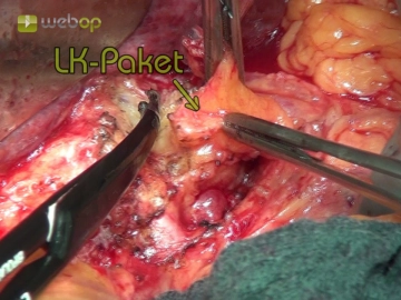 Preparation of the hepatoduodenal ligament with lymph node dissection
