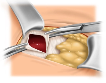 Exposure of the Umbilical Defect