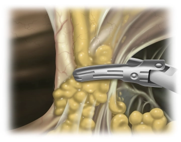 Insertion of the first working trocars and division of the Lig. teres hepatis and the Lig. falciforme