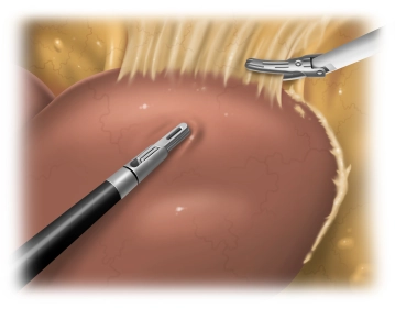 Mobilization of the Liver