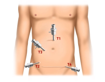 إنشاء الاسترواح البريتواني (Pneumoperitoneum) ووضع الـ Trokare