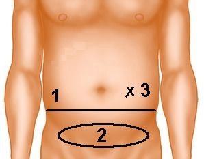 Exposure of the posterior rectus sheath layer and opening of the peritoneum