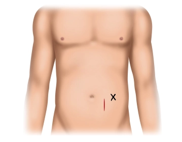 Pararectal skin incision and exposure of the anterior rectus sheath