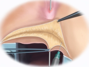 Fistula Probing, NaCl Injection, and Transverse Incision at the Perineum