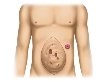 Findings; Skin Incision
