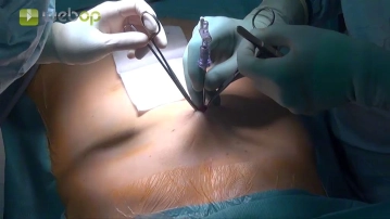 Anlage des Pneumoperitoneums und Platzieren des Optiktrokars
