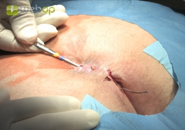 Depiction of Fistula Tracts