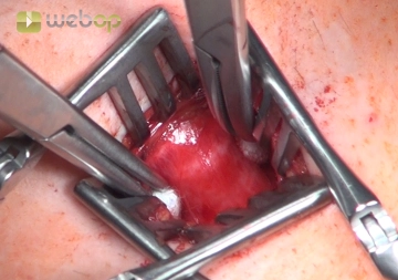 الوصول إلى الرغامى (Trachea)