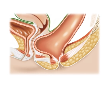 Findings Collection; Preparation of an Anterior Mucosal Flap
