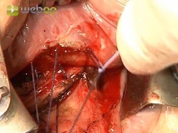 Plication of the Muscle