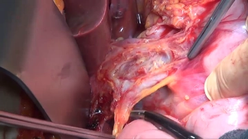 Lymphadenectomy I (Lig. hepatoduodenale/Station 12 and 13)