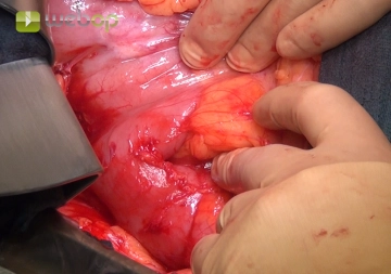 Conversion to Laparotomy