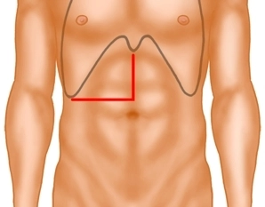 Laparotomy; Exploration