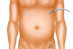 Creation of the capnoperitoneum