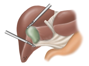 Exposure of the gallbladder
