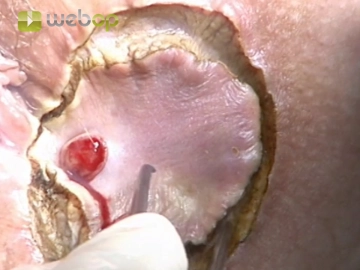 Excision of the External Fistula Opening