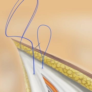 Continuous Fascial Closure with the Loop; Cranial Suture