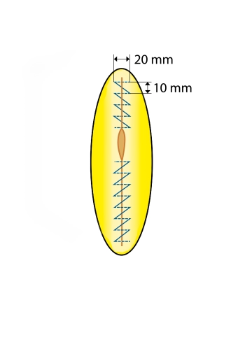 Continuous Fascial Closure with the Loop; Caudal Suture