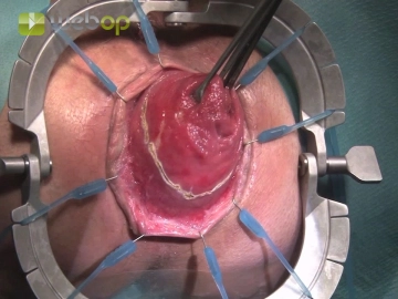 Insertion of the Anal Retractor; Incision of the Rectal Wall
