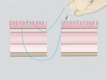 Transection of the External Rectal Wall Duplication