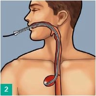 Insertion and placement of the overtube in the insufficiency cavity