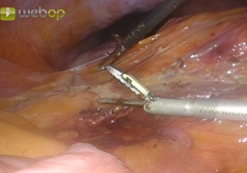 Mobilization of the ascending colon with detachment of the right flexure